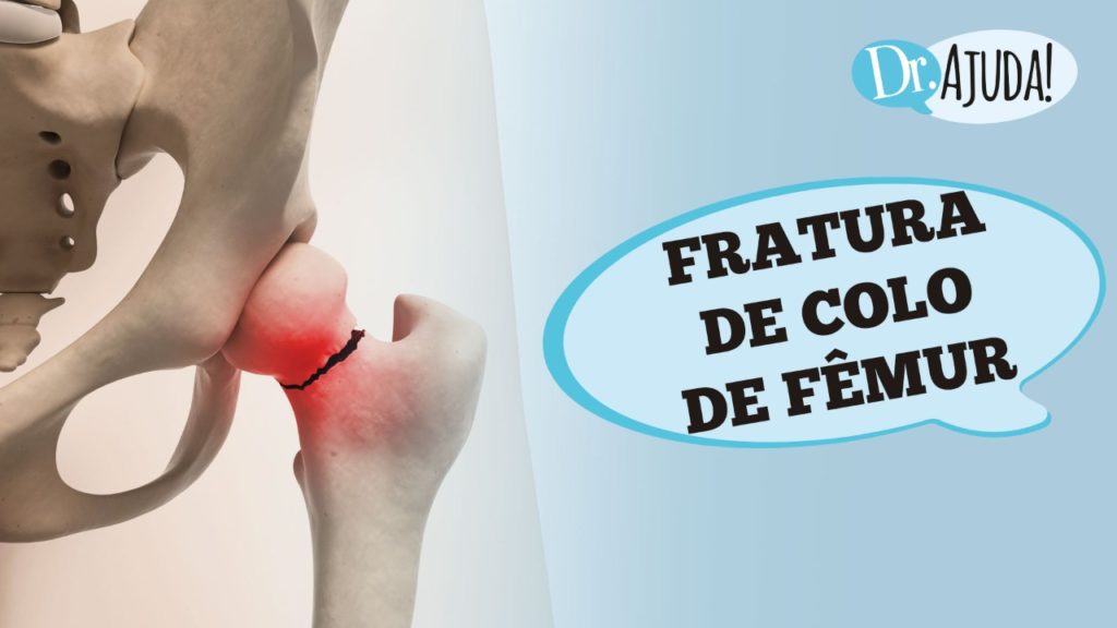 Fratura do fêmur: saiba quais os fatores e grupos de risco