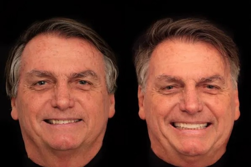 Ex-presidente Jair Bolsonaro faz harmonização facial; veja o antes e depois