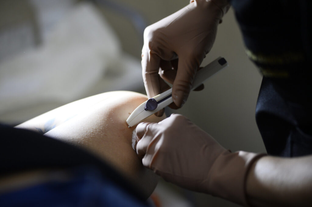 Implanon: novo método contraceptivo está disponível nas UBs do DF